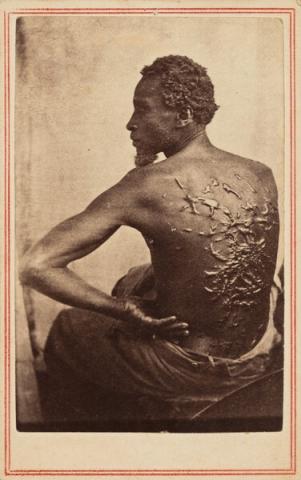 Black man seated with back turned to viewer. Numerous scars visible on man's skin.